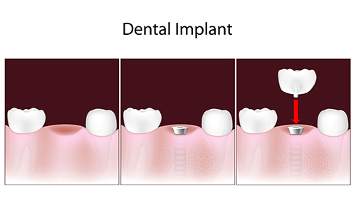 Dental Implants in Elmwood Park